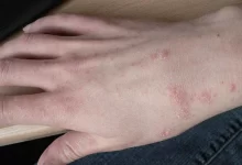 Qoturluq və ya Qotur Xəstəliyi haqqında (Scabies)