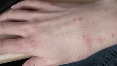 Qoturluq və ya Qotur Xəstəliyi haqqında (Scabies)