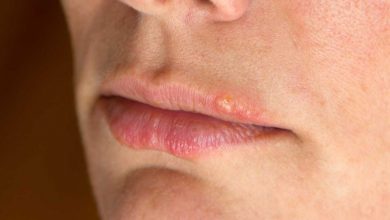 Herpes Simplex (Sadə Herpes)