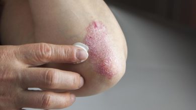 Psoriaz (Pullu dəmrov)