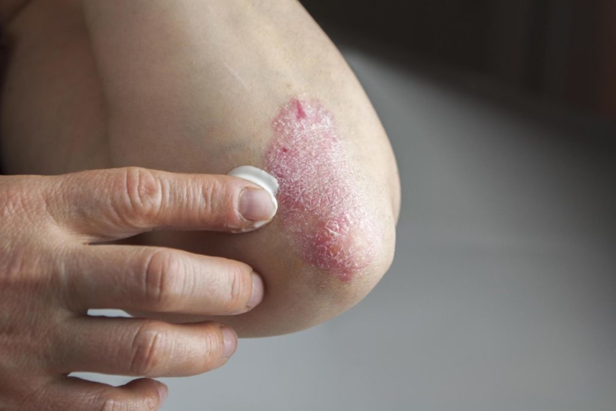 Psoriaz (Pullu dəmrov)