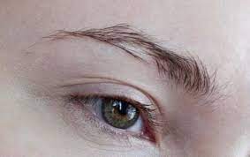 Qaşlarda Alopesiya Areata - Ocaqlı dazlıq