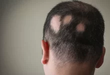 Alopesiya Areata (Ocaqlı Dazlıq, Keçəllik)