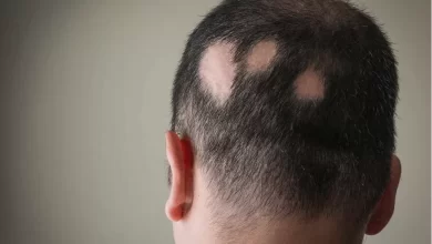 Alopesiya Areata (Ocaqlı Dazlıq, Keçəllik)