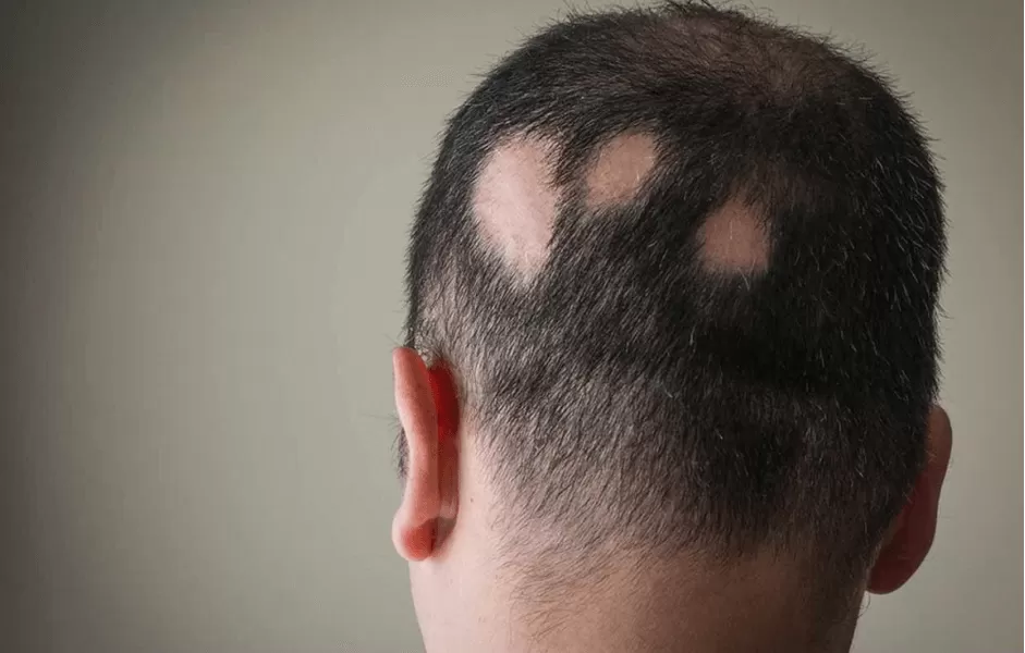 Alopesiya Areata (Ocaqlı Dazlıq, Keçəllik)