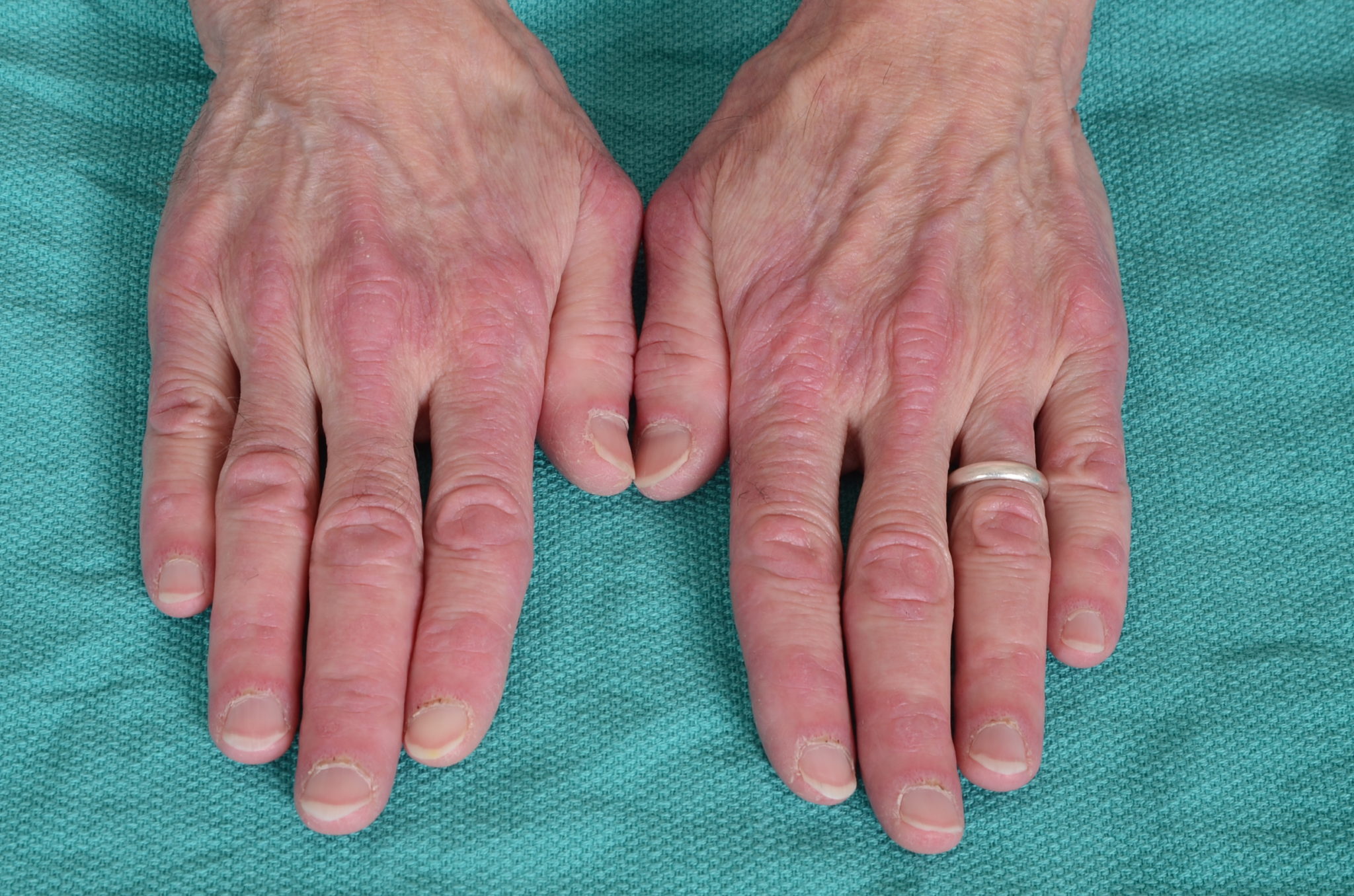 Dermatomiozit xəstəliyi