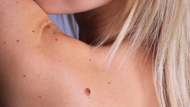 Melanoma nədir və necə müalicə olunmalıdır.
