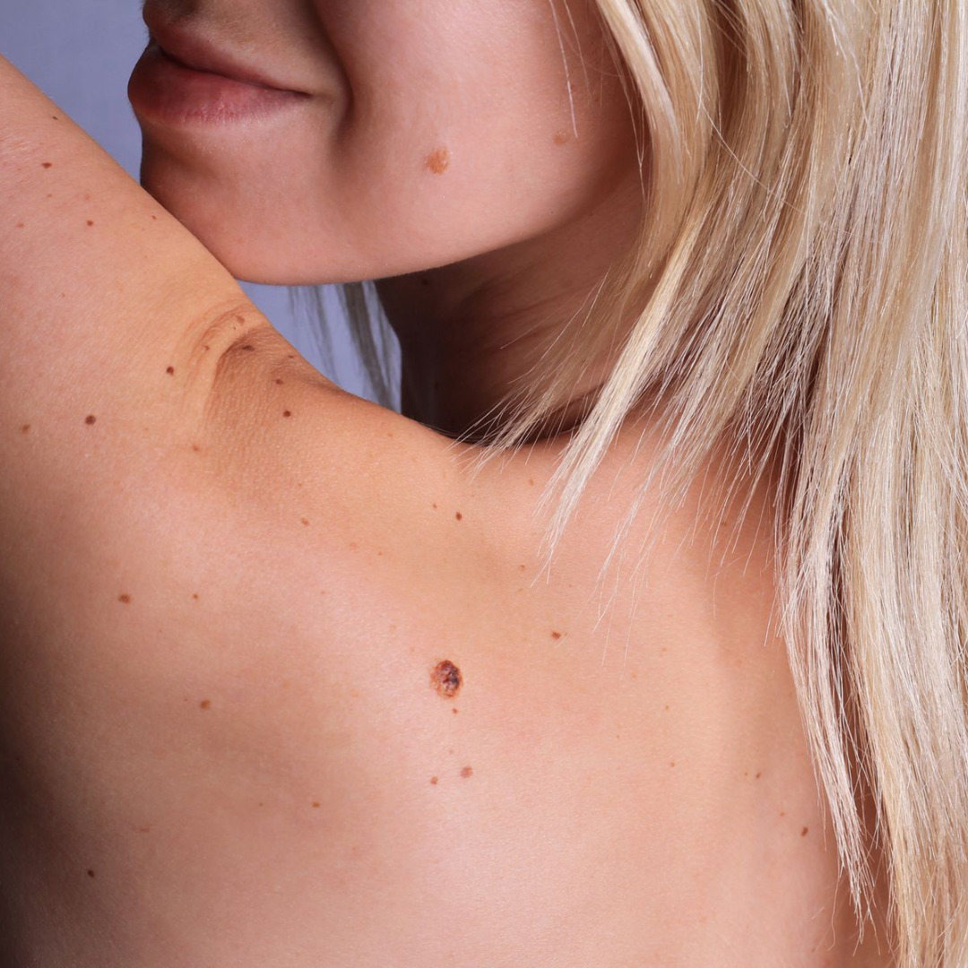Melanoma nədir və necə müalicə olunmalıdır.