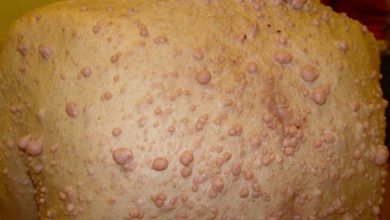 Neyrofibromatoz (Reklinqxauzen xəstəliyi)