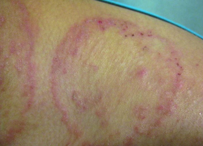 Tinea corporis