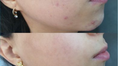 Acne Vulgaris