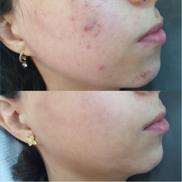 Acne Vulgaris