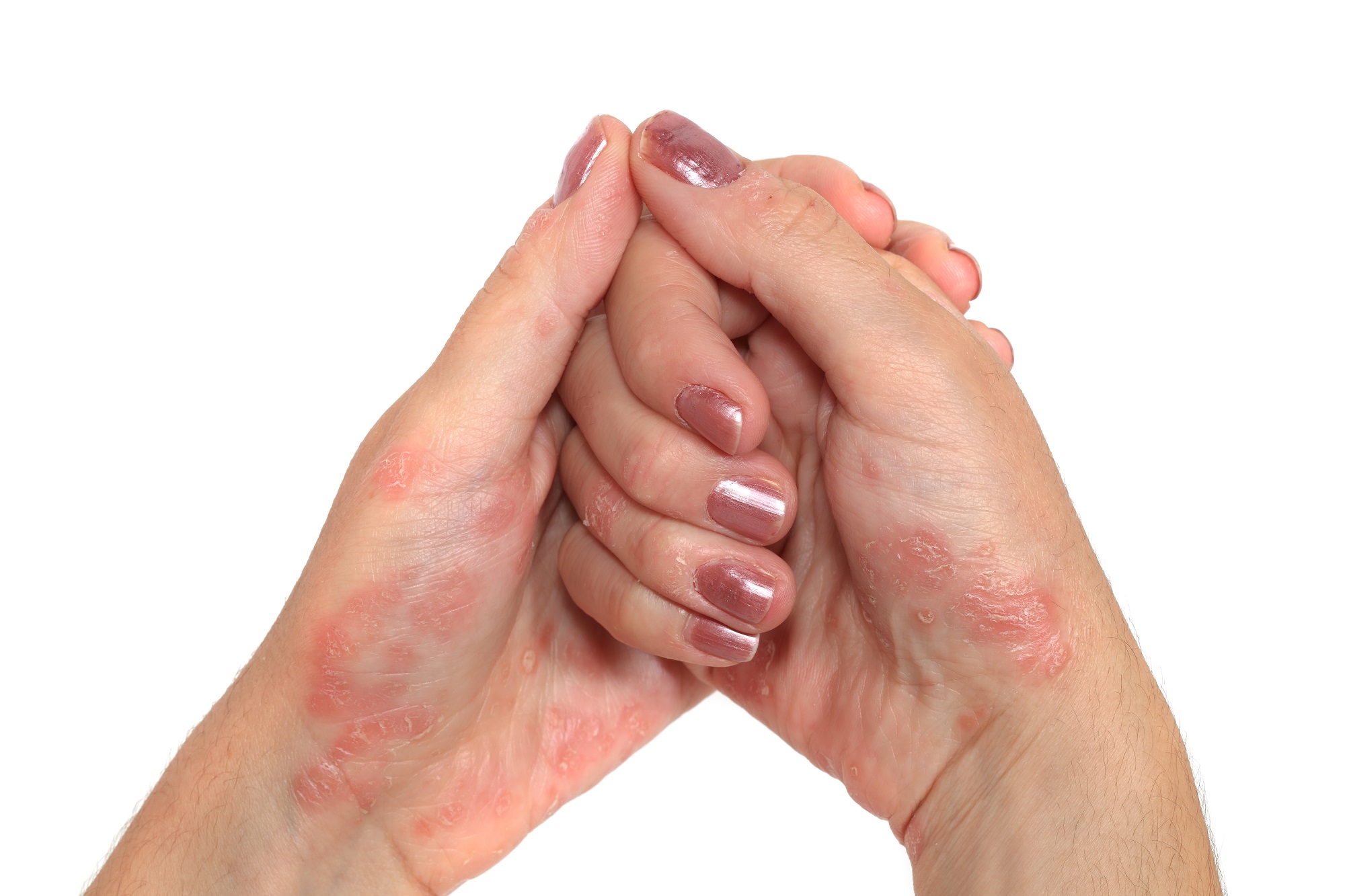 Kontakt Dermatit nədir?