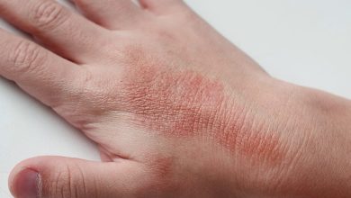 Dermatitis Herpetiformis