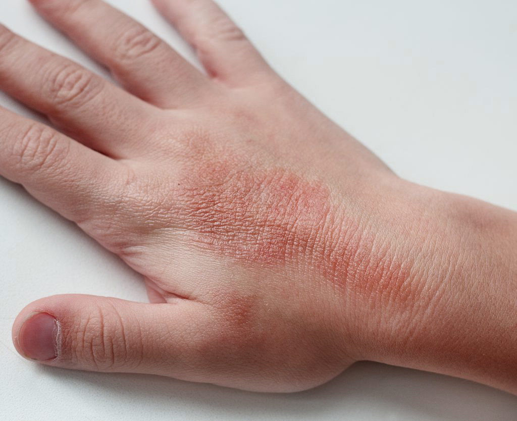 Dermatitis Herpetiformis
