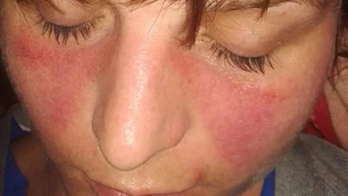 Qırmızı Qurd Eşənəyi (Lupus xəstəliyi) diaqnozu