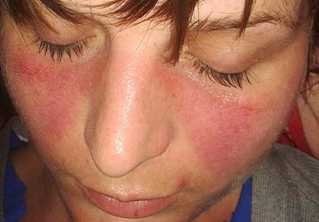 Qırmızı Qurd Eşənəyi (Lupus xəstəliyi) diaqnozu