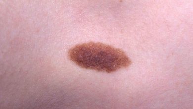 Nevus (Xal)