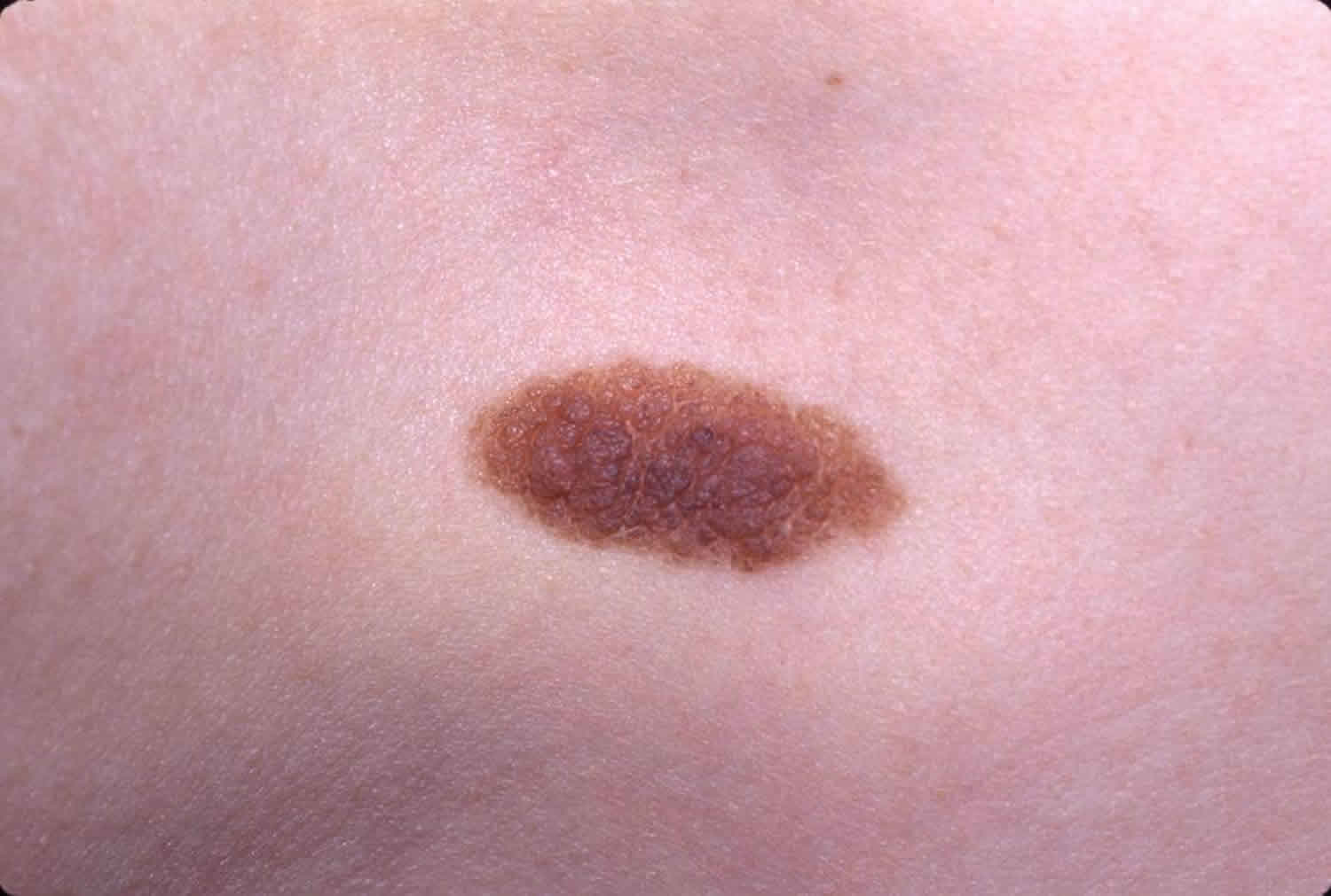 Nevus (Xal)