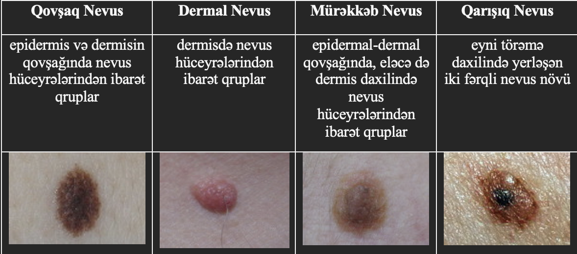 Dermatoskopiya nevusun (xalın) piqment nümunələrinə əsaslanan yeni təsnifata səbəb oldu: