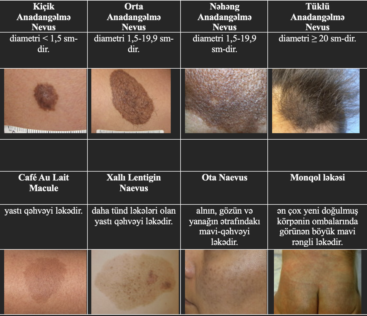 Nevusların (Xalların) patoloji təsnifatı dəridə nevus hüceyrələrinin olduğu yerdən asılıdır.