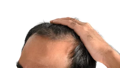 Androgenetik Alopesiya