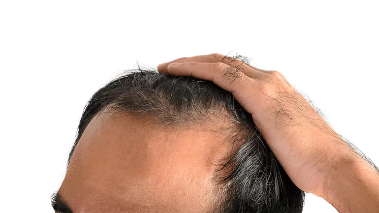 Androgenetik Alopesiya