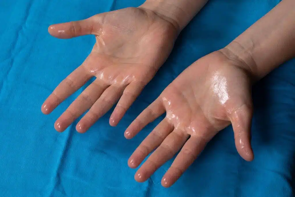 Hiperhidrozun (Həddindən artıq tərləmənin) növləri və simptomları