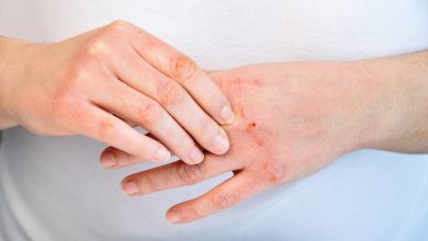 Atopik Dermatit