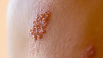 Herpes Zoster (Kəmərləyici Dəmrov) xəstəliyinin müalicəsi