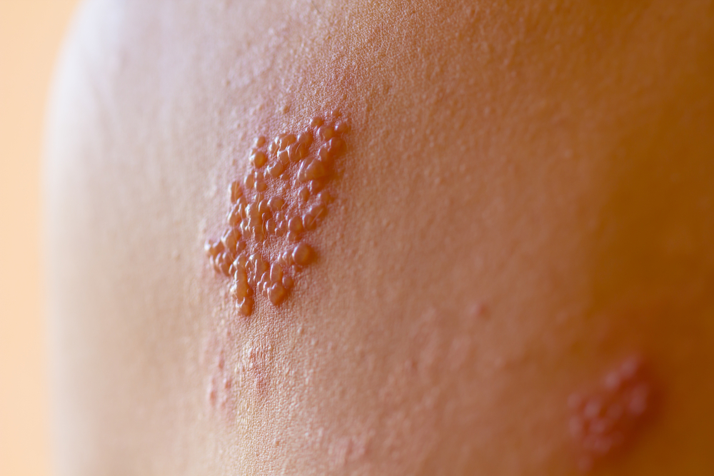 Herpes Zoster (Kəmərləyici Dəmrov) xəstəliyinin müalicəsi