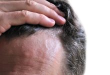 Seboreya Dermatiti haqqında hərşey