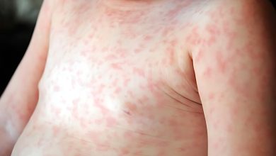 Roseola İnfantum infeksiyasının qarşısının alınması