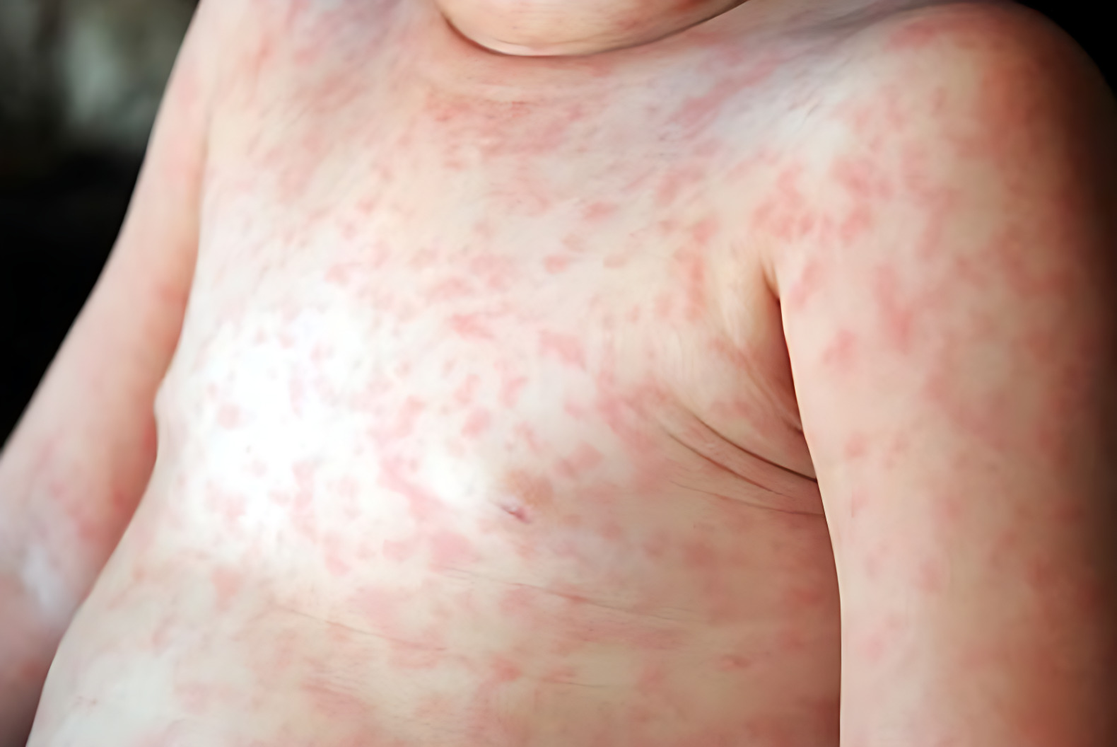 Roseola İnfantum infeksiyasının qarşısının alınması