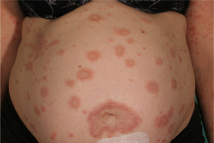 Hamiləlik Pemfiqoidi (Pemphigoid Gestationis)
