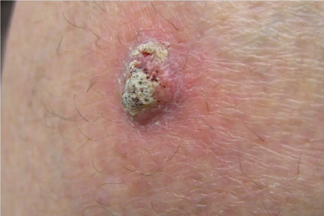Squamos Cell Carcinoma (Yastıhüceyrəli Dəri Xərçəngi)