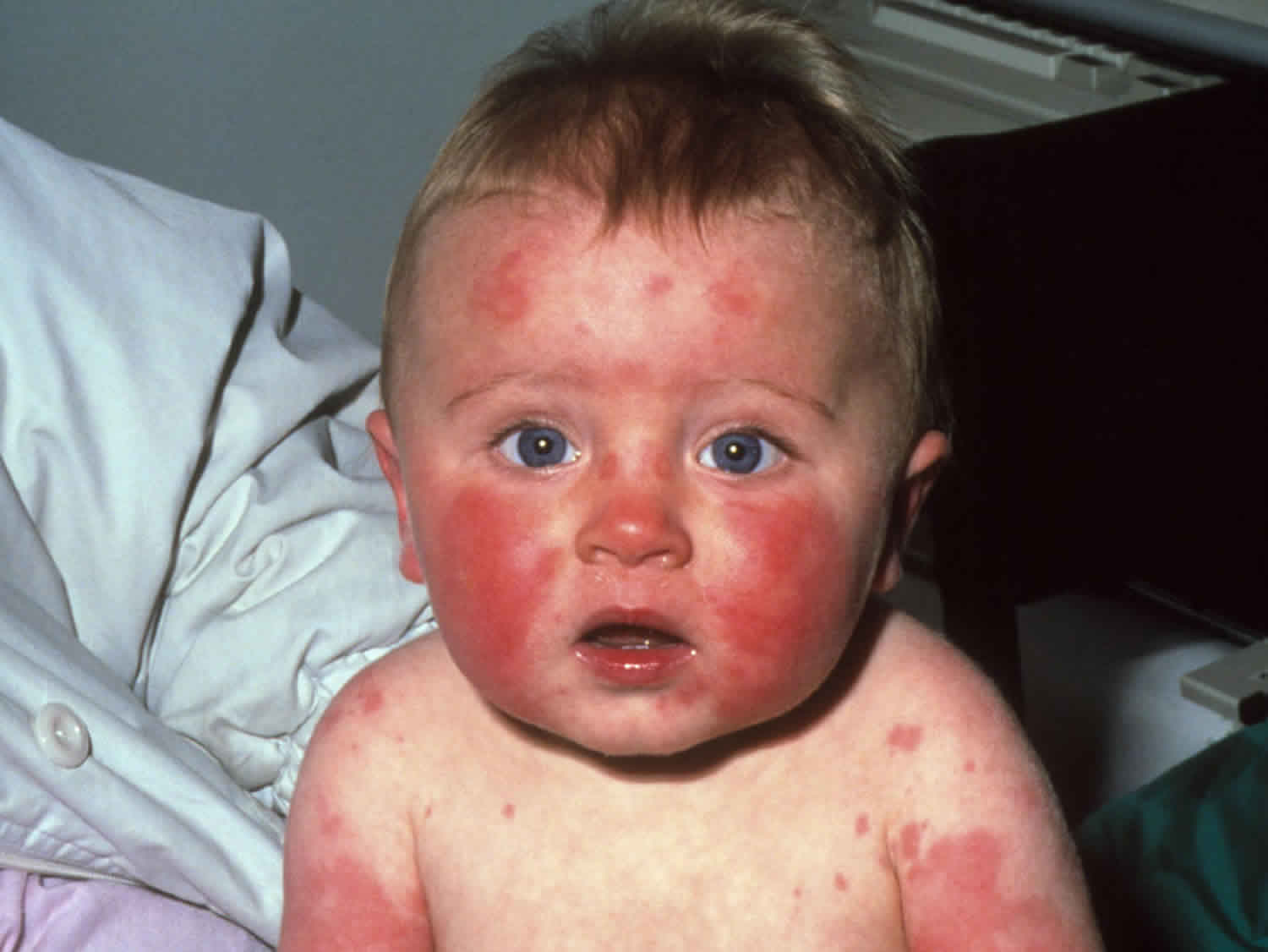 Erythema İnfectiosum