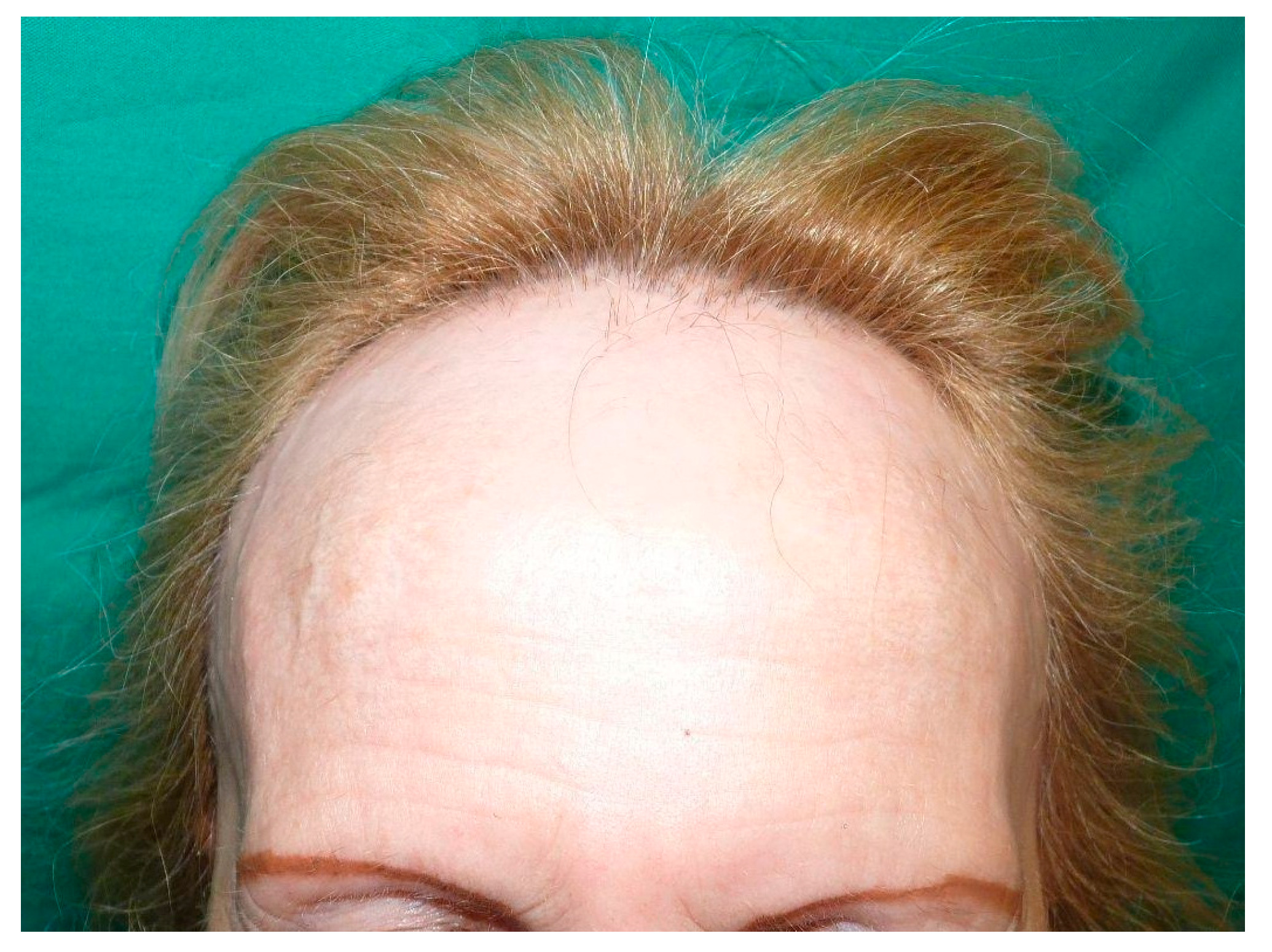 Frontal Fibrozlu Alopesiya (FFA)