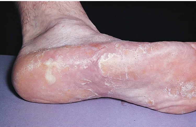 Tinea pedis - Mokasin-tip (hiperkeratotik) forma
