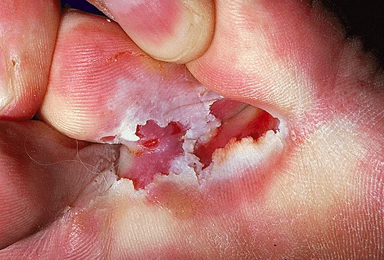 Tinea Pedis - Ulserativ forma