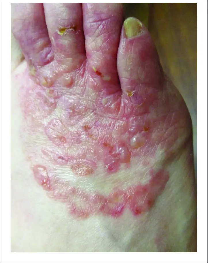 Tinea Pedis - Vezikulyar forma